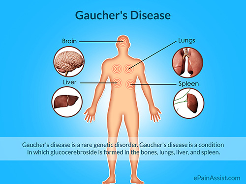 Gaucher's Disease