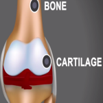 Ins and Outs of Joint Bleeds